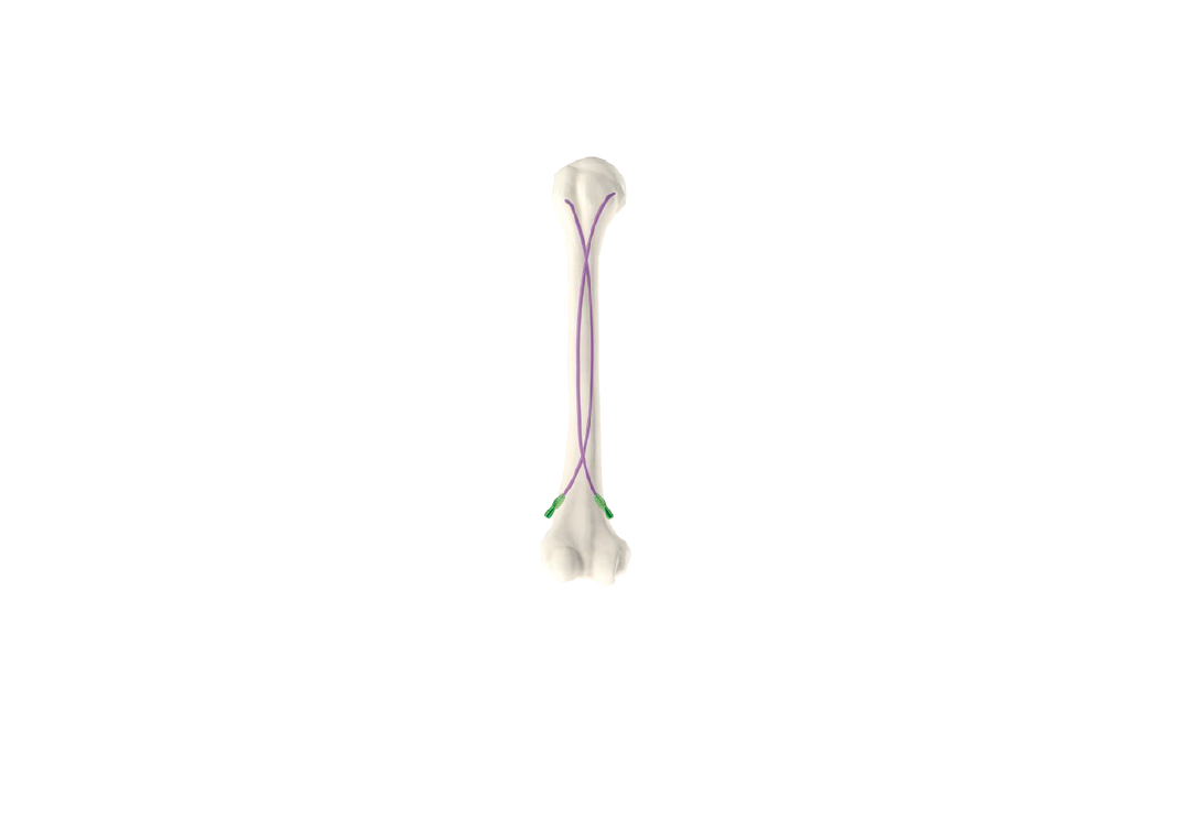 Elastic Intramedullary Nail(NE-01)