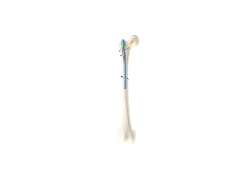 Femoral Intramedullary Nail (NF-02)