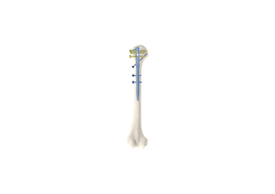 Humeral intramedullary Nail(NH-05)