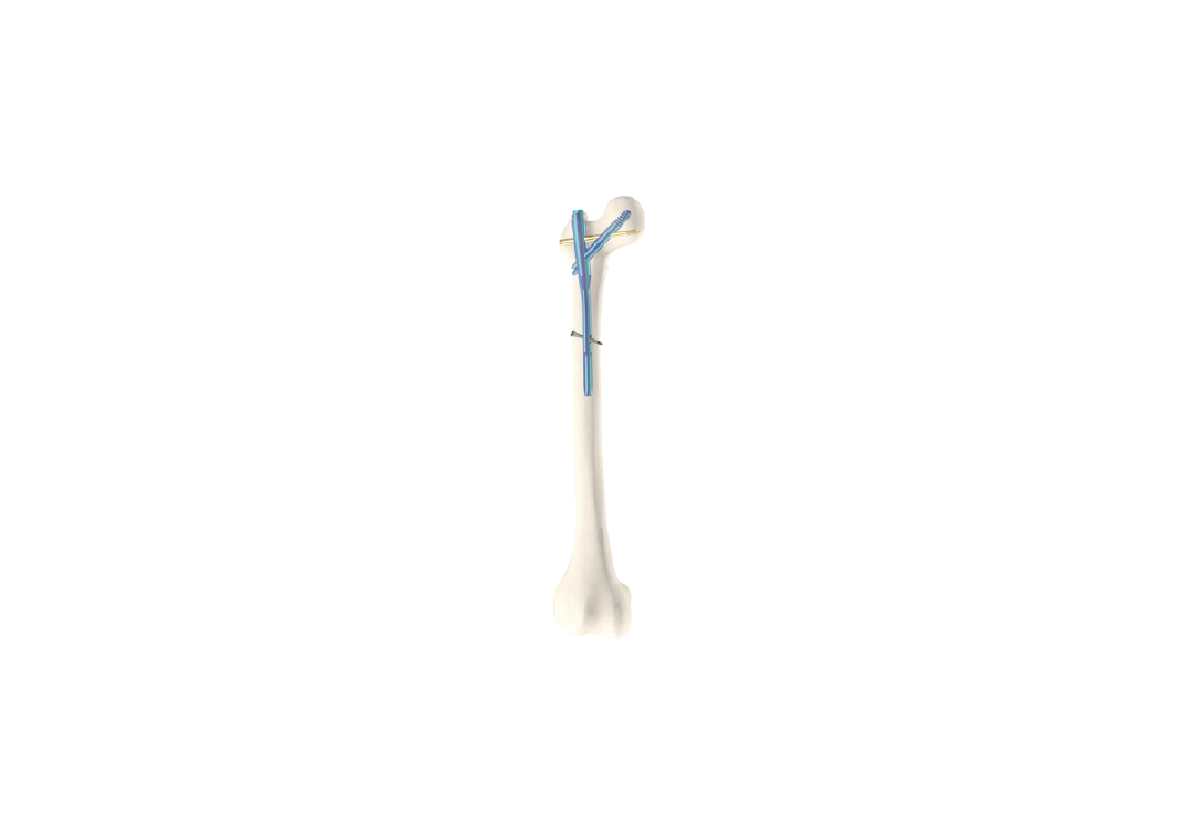 Femoral Intramedullary Nail(LNF)